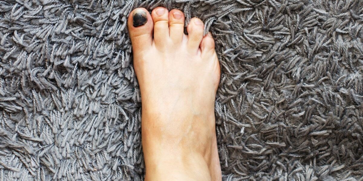 Czarne paznokcie u nóg po bieganiu- co robić i kiedy iść do podologa?