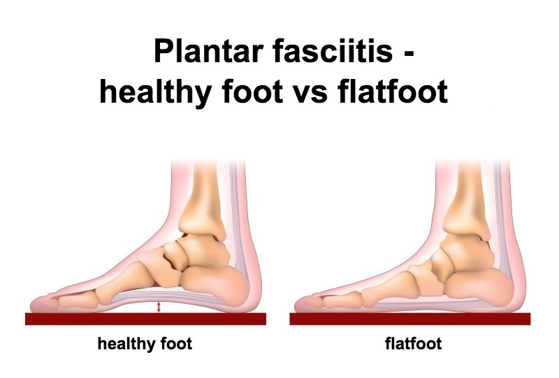 Plantar fascitis - Pain in the heel after running 